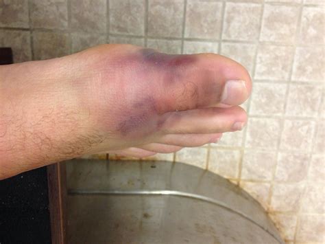 Walking on a broken toe hurts every time your body engages it, which is why those who must walk on a broken tie are better off taking some. Inside the freak accident that almost changed the ...