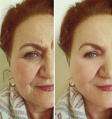 Face Old Woman Wrinkles Before And After Correction Mature Tension
