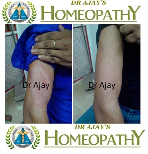 Dr Ajays Homeopathy Homeopathy Is Best For Recurrent Fungal