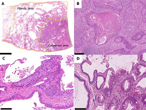 Lung Cancer Histology Types