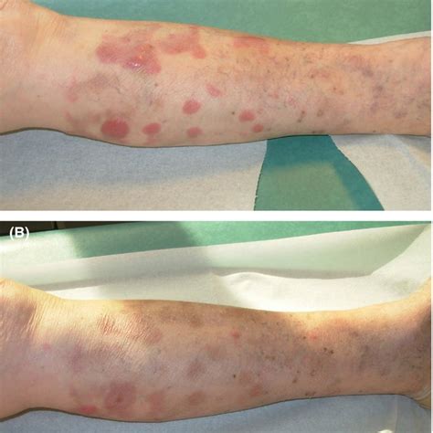 A Progressing Lymphoma At Left Leg With Multiple Growing Tumors B