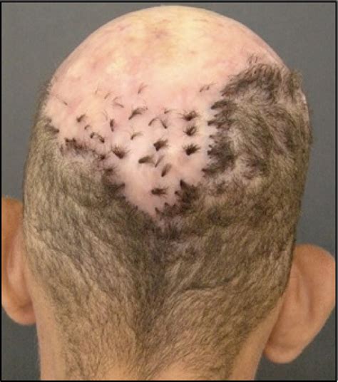 Image Gallery Exuberant Tufted Folliculitis Affecting The Scalp