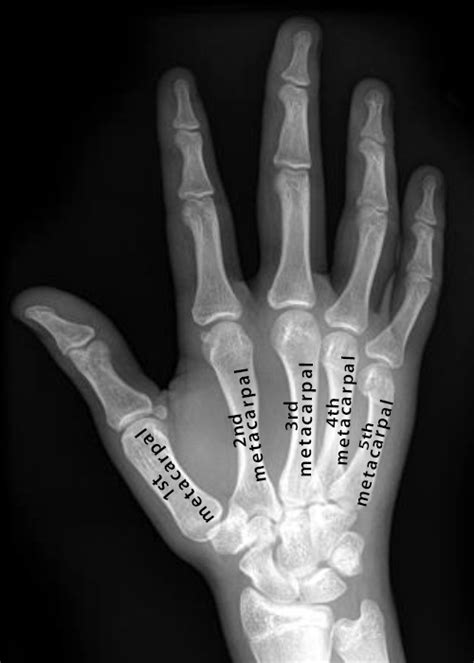 The following 176 pages are in this category, out of 176 total. Metacarpals: Definition, Location, Anatomy, Function, Diagram