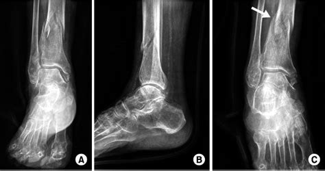 An 80 Year Old Female Patient With A Spiral Distal Tibial Fracture A