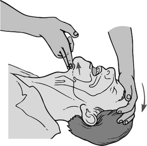 Assessment And Management Of The Airway Anesthesia Key
