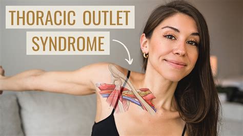 Thoracic Outlet Syndrome Exercises How To Fix It Causes Symptoms