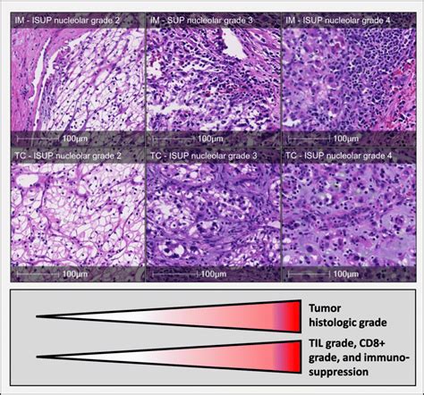 Histopathology Heterogeneity And Immune Cell Infiltration In Ccrcc