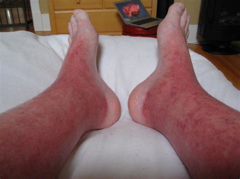 Topical Steroid Withdrawal May 2012