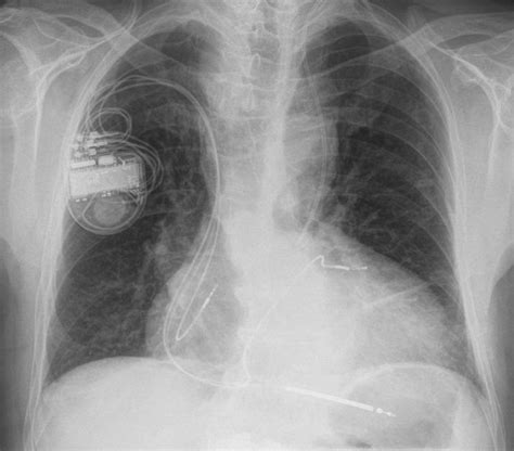Here the porgram lists the titles of the icd categories in which your search keywords are found. Kardiologie - Herzschrittmacher, Defibrillatoren, kardiale ...