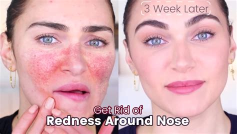 How To Get Rid Of Redness Around Nose Health For Best Life
