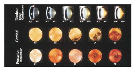 Figure 1 From Clinical Application Of The Lens Opacities Classification