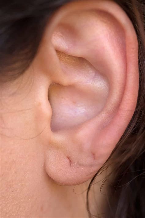 Effective Earlobe Repair For Damage Caused By Heavy Earrings