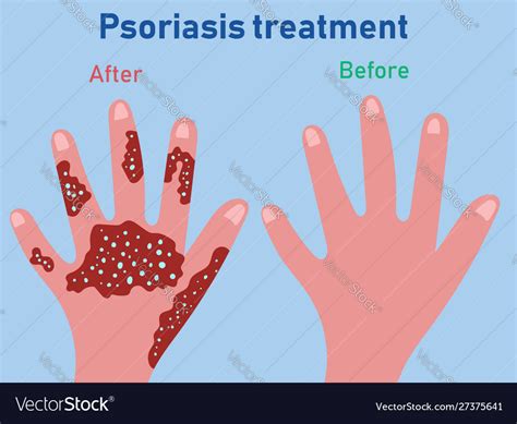 Treatment Psoriasis Before And After Royalty Free Vector