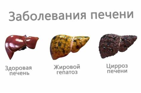 Диета при гепатозе печени жировой Забудьте о Жировом гепатозе: Пять шагов, чтобы вернуть здоровье вашей Забудьте о Жировом гепатозе: Пять шагов, чтобы вернуть здоровье вашей Диета при гепатозе печени жировой