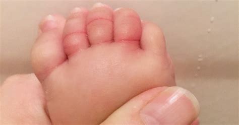 What Is A Hair Tourniquet And How To Keep Babys Toes Safe