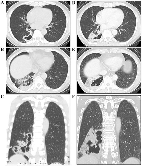 Invasive Mucinous Adenocarcinoma Of The Lung Presenting As A Large