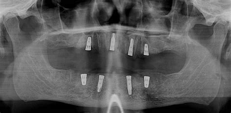 Upper Fixed Implant Bridges Delayed Temporary Upper Zirconium