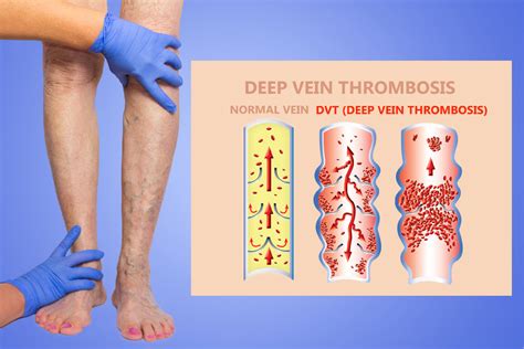 Deep Vein Thrombosis And Blood Clots In Your Legs