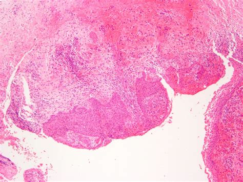 Eruption Cyst Histology