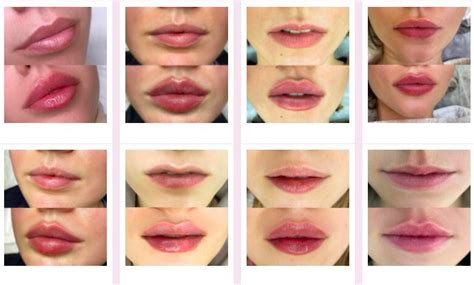 Lip Filler Before And After Photos And Results The Daily Glimmer