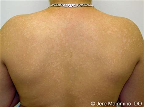 Tinea Versicolor American Osteopathic College Of Dermatology Aocd