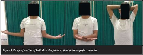 Simple Bilateral Anterior Shoulder Dislocation A Case Report And Review Of The Literature