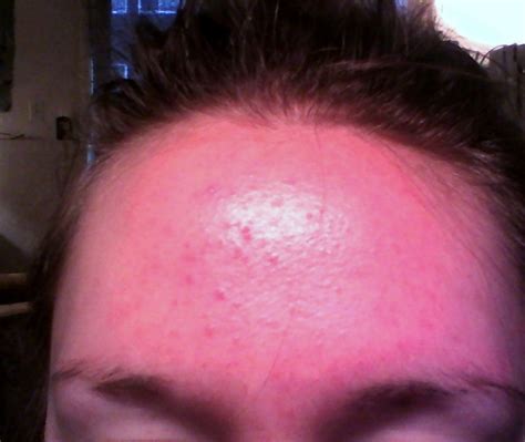 I Have Had Small Red Spots Around My Forehead Nose And Sometimes