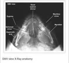 Waters pa right and left lateral of nasal bones. X-ray of facial structures, Waters view: I remember those ...