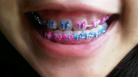 Why The Fake Braces Trend May Be Dangerous For Users