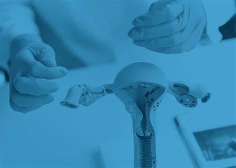 Laqueadura Tubária O Que é