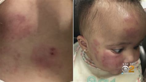 6 Month Old Badly Bruised At Daycare Real Dark News