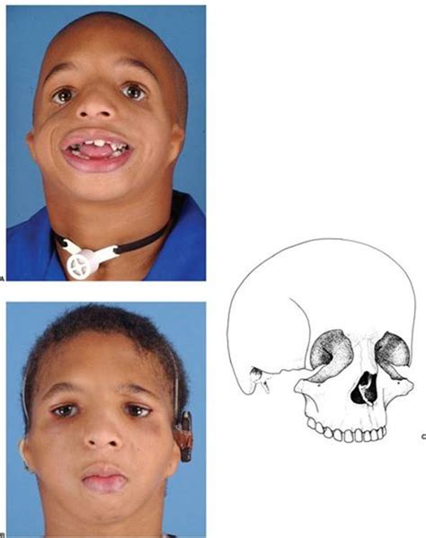 Craniofacial Clefts And Hypertelorbitism Grabb And Smiths Plastic