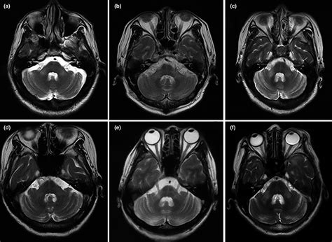 Bilateral Middle Cerebellar Peduncle Lesions Neuroimaging Features And