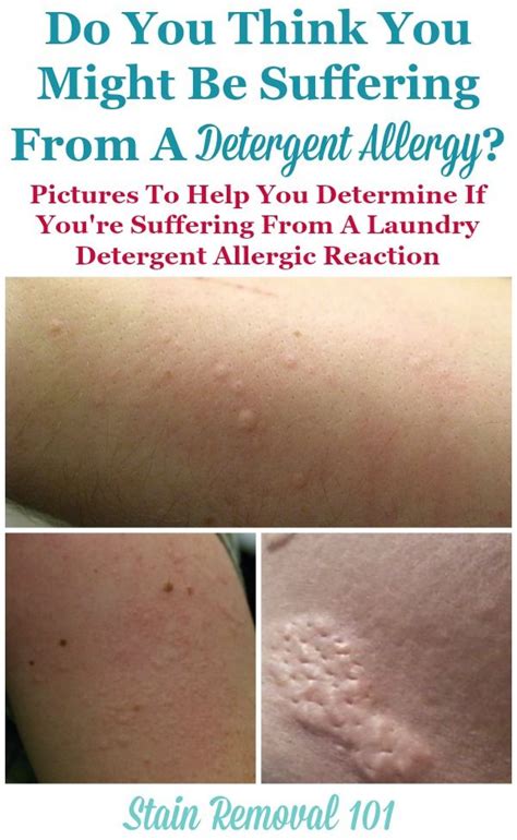 Allergic Reaction Rash To Laundry Detergent Causes Symptoms And