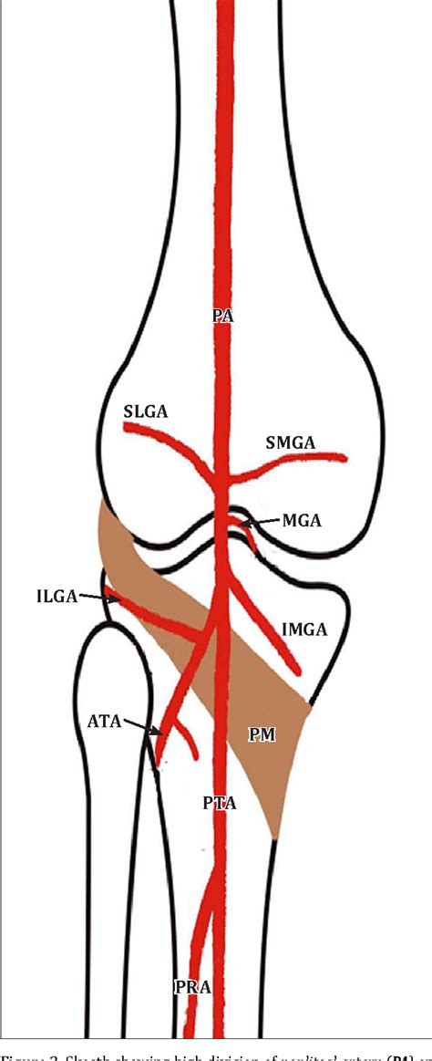 High Division Of The Popliteal Artery â A Case Report Semantic Scholar