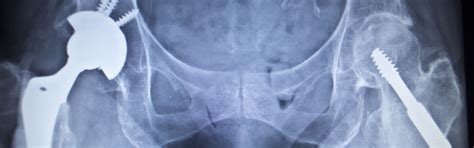 Defective Hip Implant Lawyers Depuy And Stryker Hip Injury Lawsuits