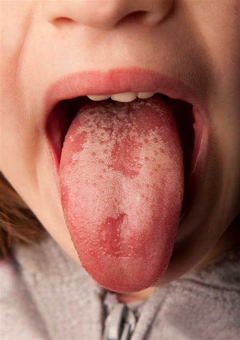 Covid Tongue Happipuncture