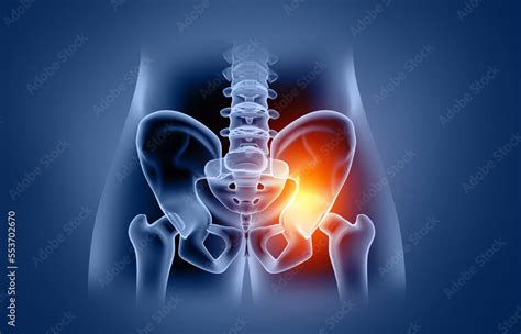 An Overview Of Hip Pain One Side Pain Conditions Causes And