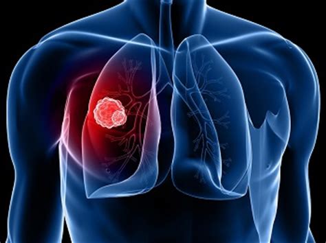 Lung cancer is the deadliest type of cancer, causing more than 150,000 deaths annually in the lung cancer symptoms also resemble those of many other conditions, making it hard to discern the national cancer institute: 10 Early Warning Signs of Lung Cancer | VICTORY OVER CANCER