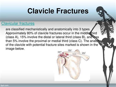 Ppt Clavicle Fractures Powerpoint Presentation Free Download Id