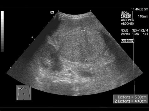 Sonogram vs ultrasound vs sonography. File:Ultrasound abdomen - liver cirrhosis - 10.jpg ...