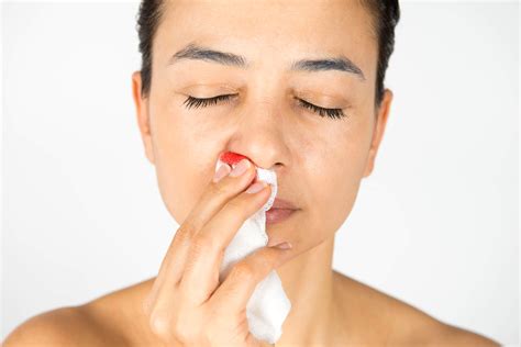 What You Need To Know About Nosebleeds