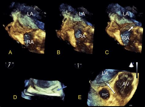 Guidelines For The Echocardiographic Assessment Of Atrial Septal Defect