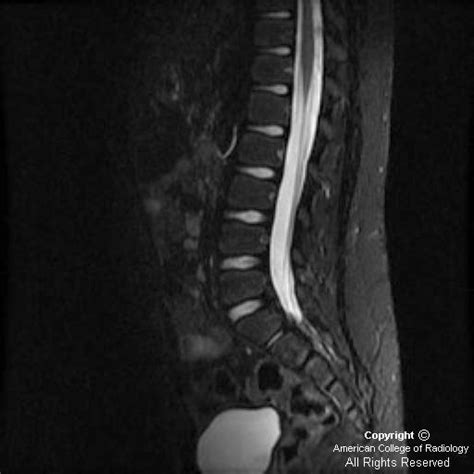 Herzlich willkommen auf den internetseiten der neurologischen klinik. Neuroradiology On the Net: Guillain-Barre syndrome (GBS)
