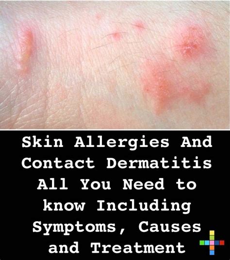 Skin Allergies And Contact Dermatitis All You Need To Know Including