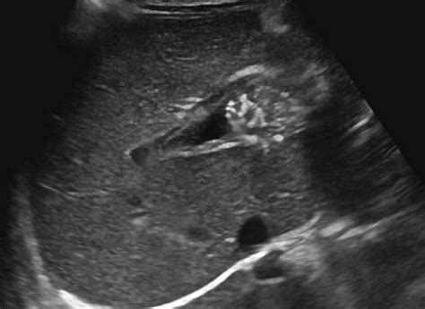 Abnormal Liver Ultrasound