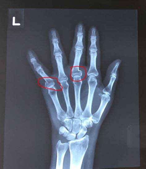 Finger Fracture 🏥singapore Orthopaedic And Sports Medicine