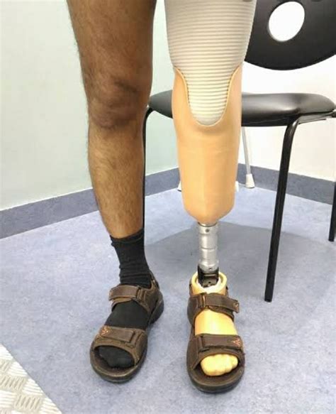 Functional Prosthetic Below Knee Prosthesis Artificial Limb Walking