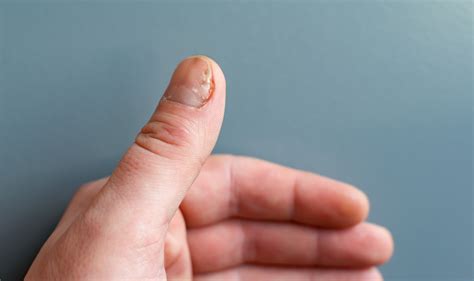 Hautkrebs Ist Auch Unter Den Fingern Geln M Glich