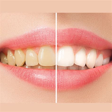 Teeth Whitening Aislinn Medical Spa